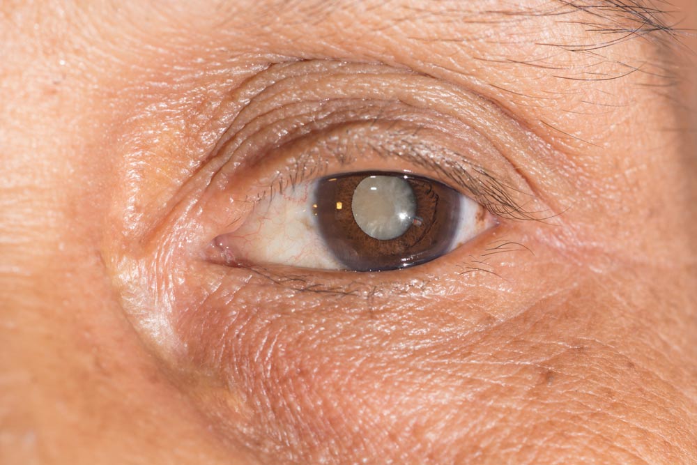 Cataract Treatment in Florence, SC